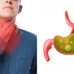 What is Alginate Therapy and Does it Help GERD? alginate therapy and gerd