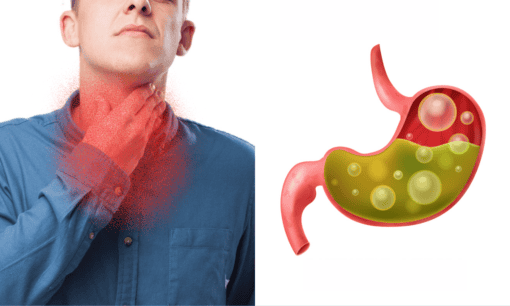 alginate therapy and gerd